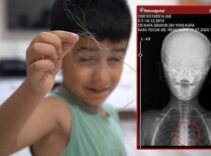 6 yaşındaki çocuk salatalık yuttu şok gerçek ortaya çıktı! '1 ay yoğun bakımda kaldı'