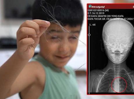 6 yaşındaki çocuk salatalık yuttu şok gerçek ortaya çıktı! '1 ay yoğun bakımda kaldı'