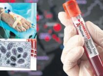 Türkiye’de ‘mpox’ iddiası