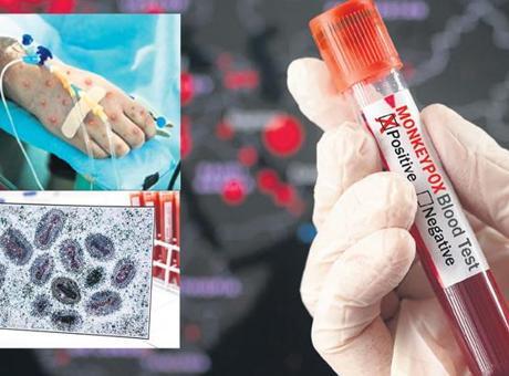 Türkiye’de ‘mpox’ iddiası
