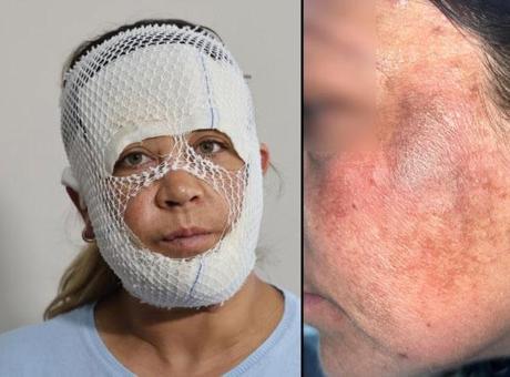 7 bin liralık ‘Prenses cilt bakımı’ kabusu: Oğlum beni görünce 'öcü' diyerek kaçtı