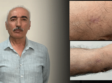 Kolundaki 1 santimetrelik yara aylarca geçmedi! Hastanede gerçeği öğrenince şoke oldu
